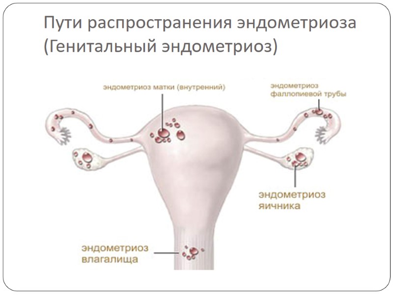 Пути распространения эндометриоза (Генитальный эндометриоз)
